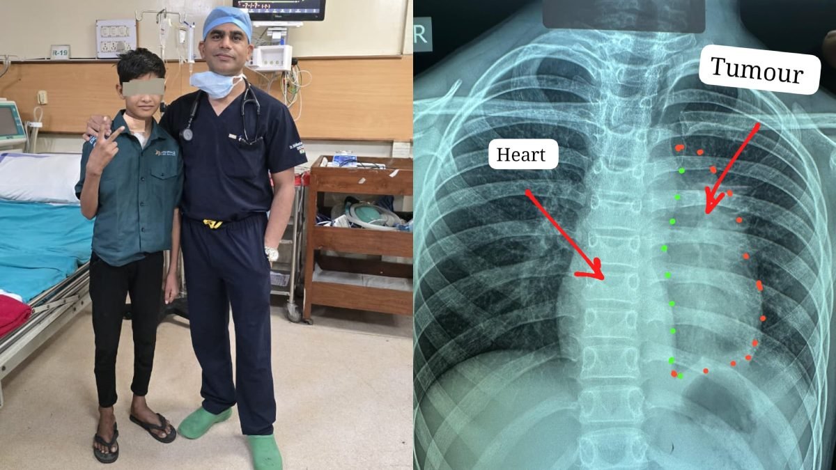 Doctors Remove Rare Cancerous Tumor Adhering to 11 Year Old Heart